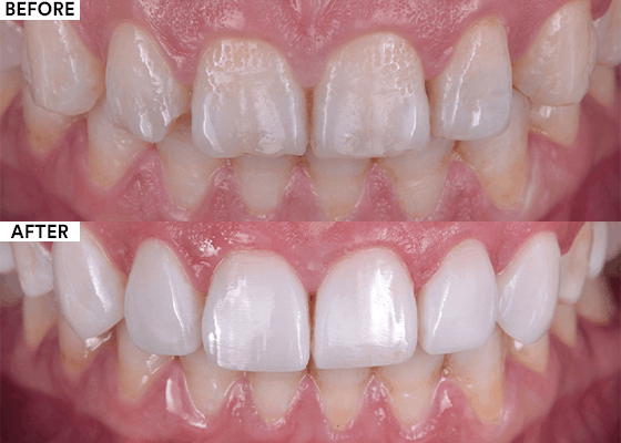 composite resin veneers before and after 