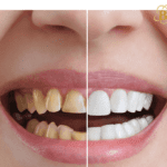 Invisalign Before And After