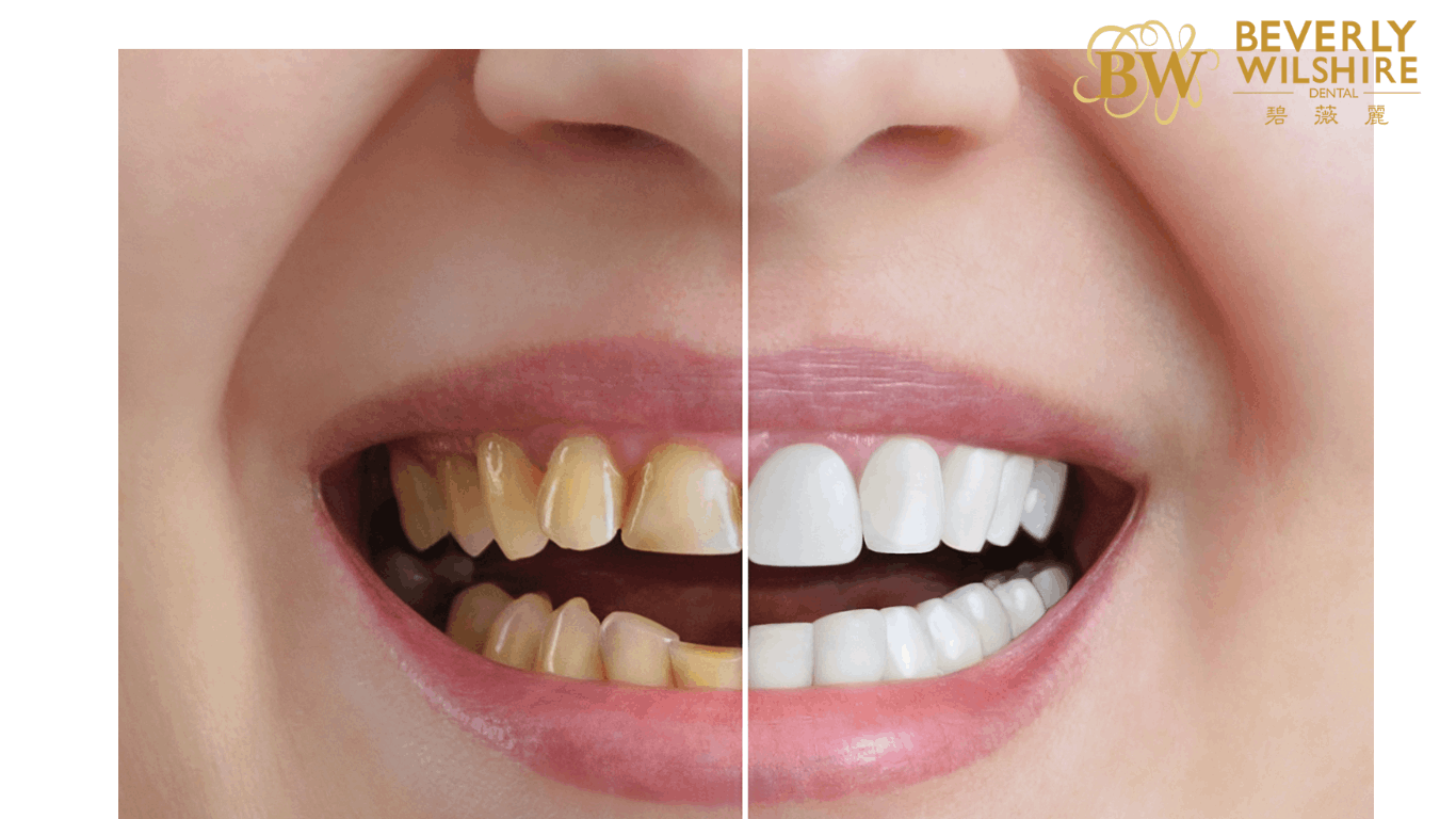 invisalign before and after
