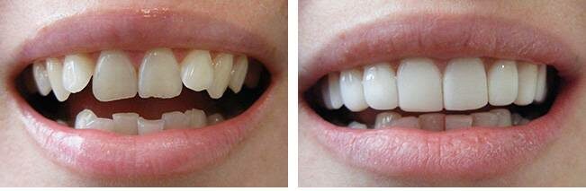 porcelain veneers before and after 