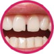 teeth with gap